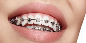 Ortodonti tedavisi ankara