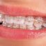 Ankara en iyi ortodonti tedavisi