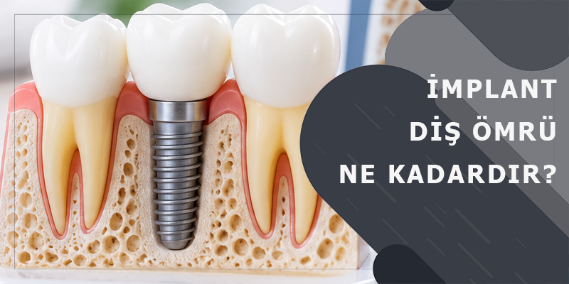 İmplant Diş Ömrü