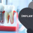 Diş İmplantlarının Fiyatı Ankara
