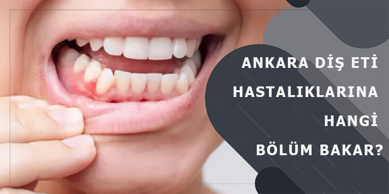 Ankara Diş Eti Hastalıkları