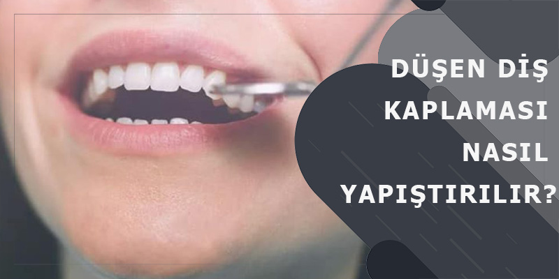 Düşen Diş Kaplaması
