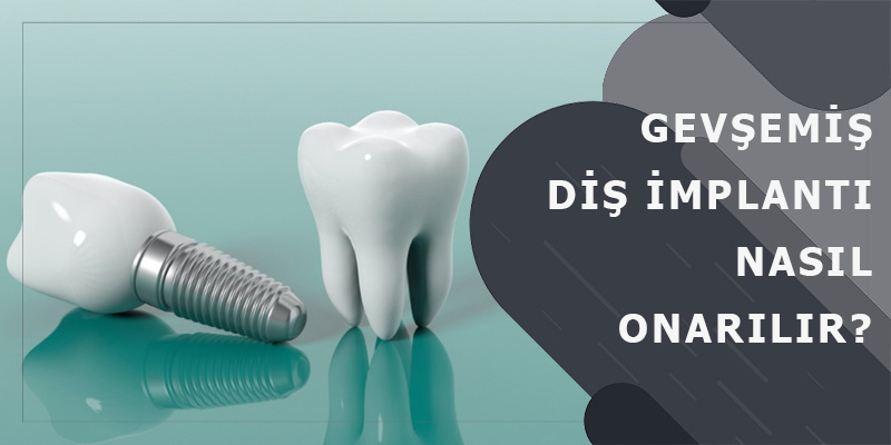 Gevşemiş Diş İmplantı Nasıl Onarılır?
