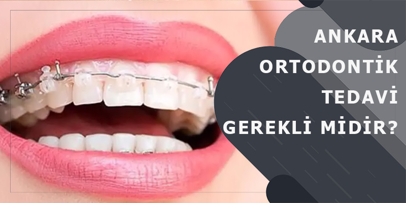 Ankara Ortodontik Tedavi