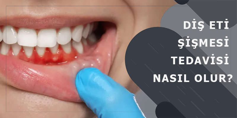 Diş Eti Şişmesi Tedavisi Nasıl Olur?