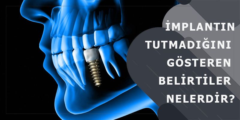 İmplantın Tutmadığını