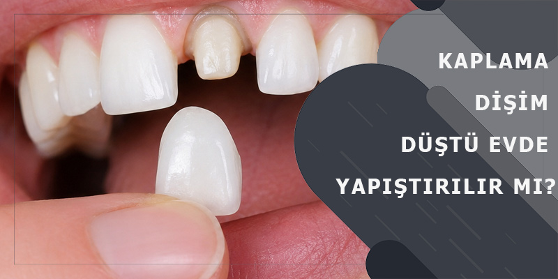 Kaplama Dişim Düştü Evde Yapıştırılır Mı?