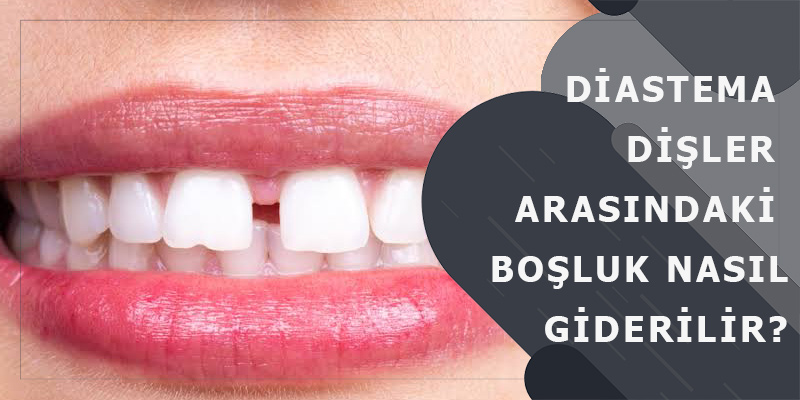 Diastema Dişler Arasındaki Boşluk